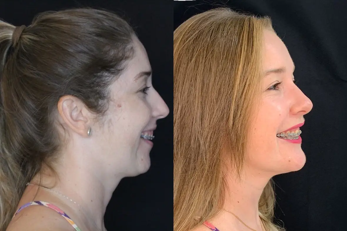 Paciente 2: perfil antes (à esquerda) e depois (à direita) da cirurgia ortognática